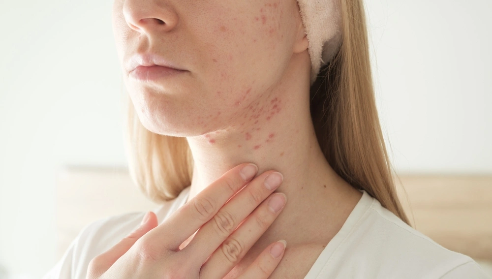 A woman holding her neck, with inflammatory acne