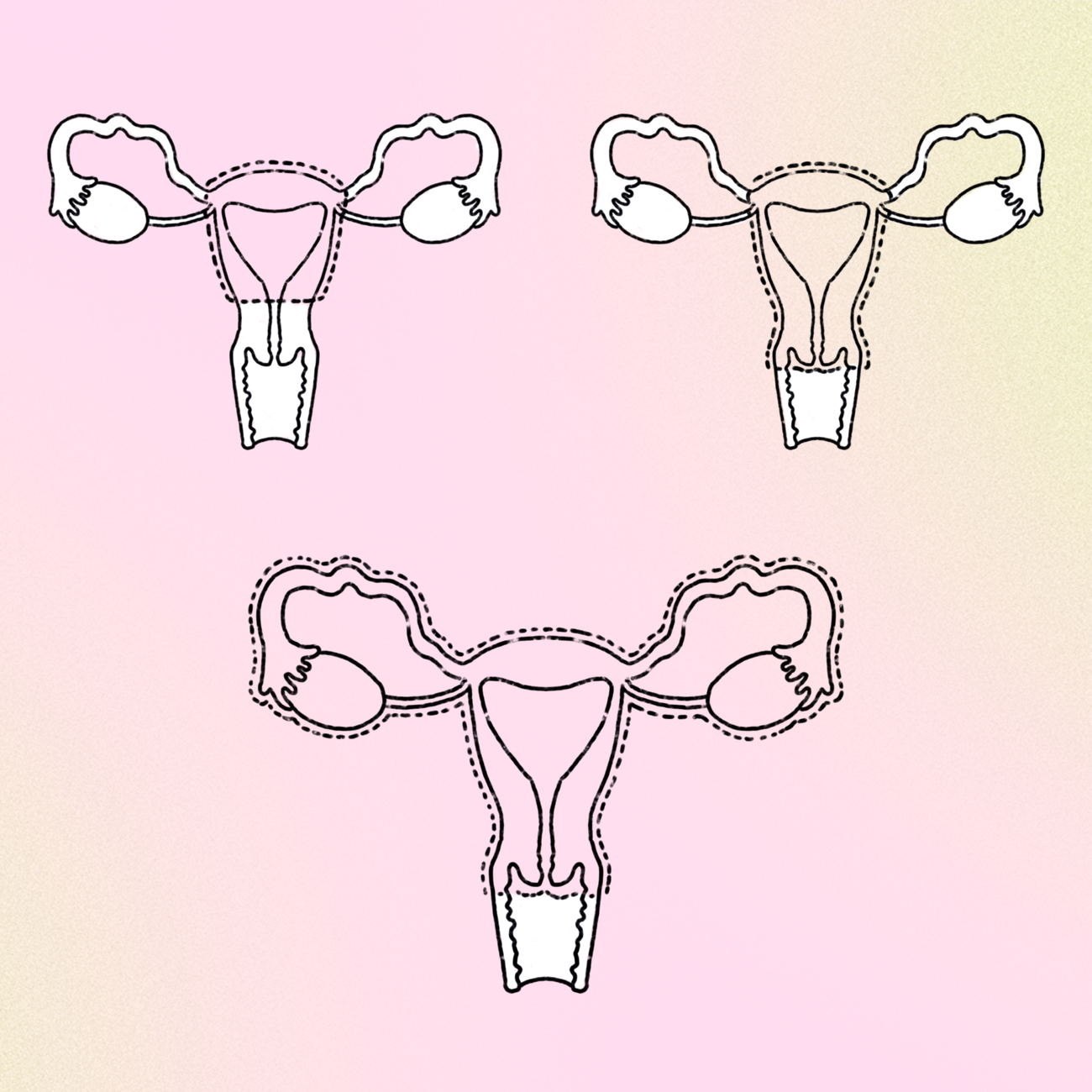 Three different types of gender affirming hysterectomy procedures.