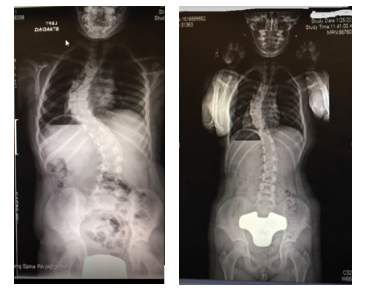 x-ray of scoliosis in children