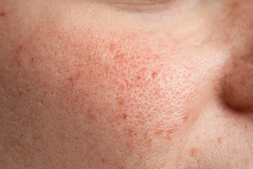 Closeup of slightly damaged skin on cheek