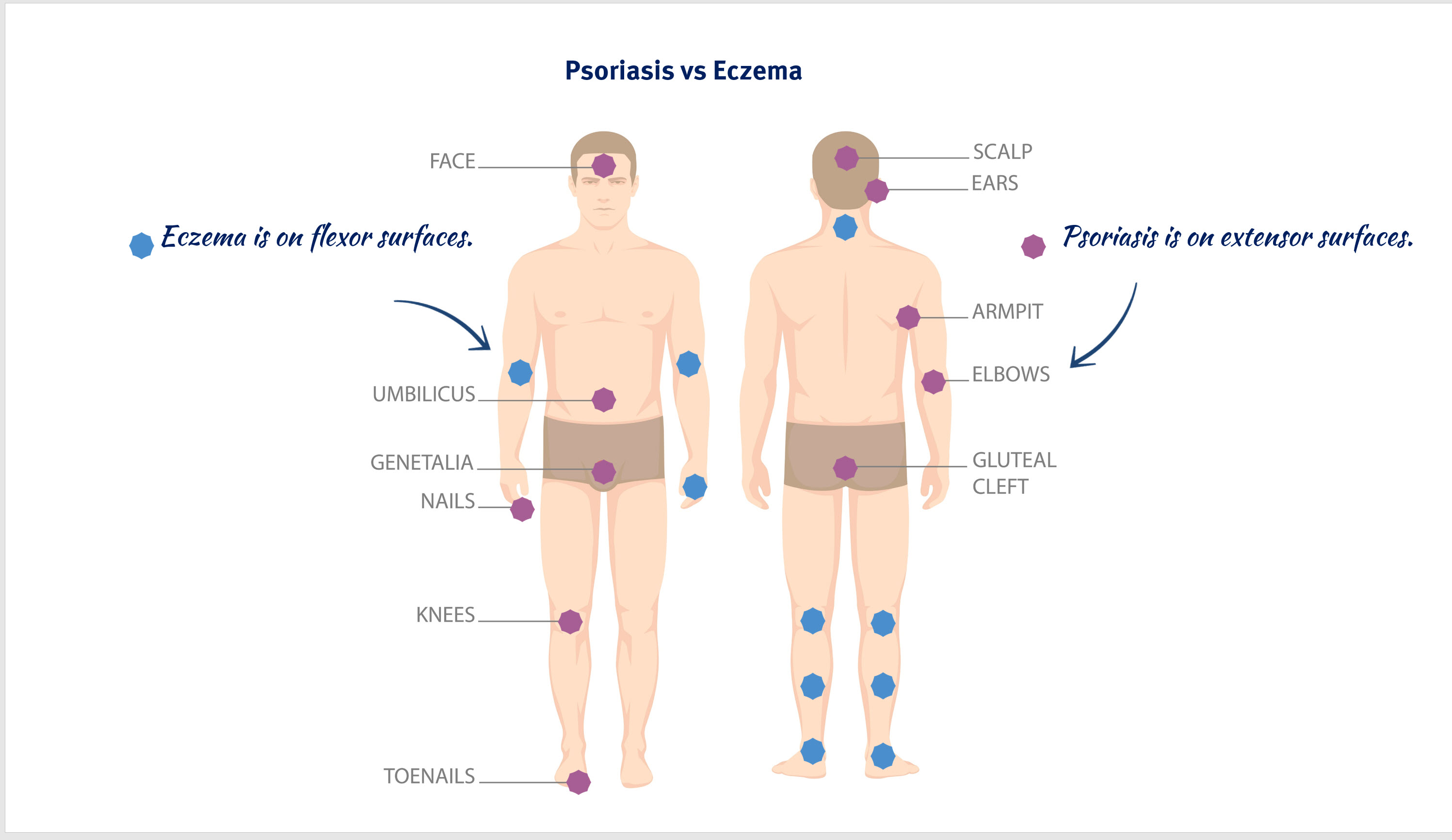 psoriasis vs eczema locations on body