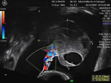 Ultrasound image of hyperstimulated ovary