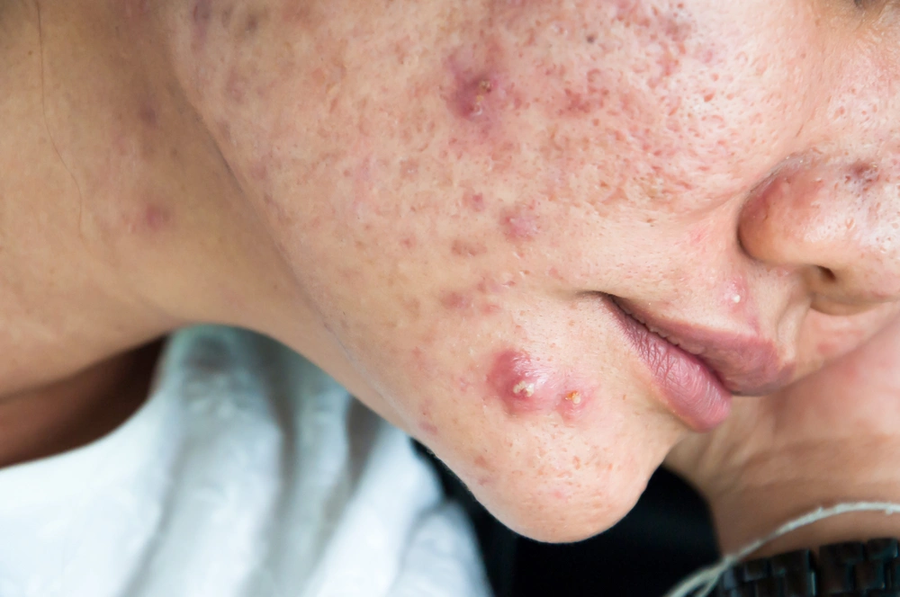 Cystic acne on someone's cheeks