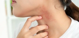 熱痱 汗疹 濕疹 成因 症狀