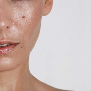 Everything To Know About Oily Skin And T-Zone Acne