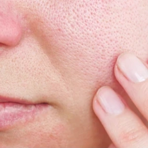 The Ultimate Guide To Minimizing Large Pores