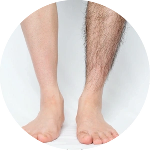 Loss of Leg Hair in Men Rex MD