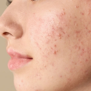 How To Tell The Difference Between Regular And Cystic Acne