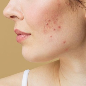 Acne Medication And Burns: Everything You Need To Know