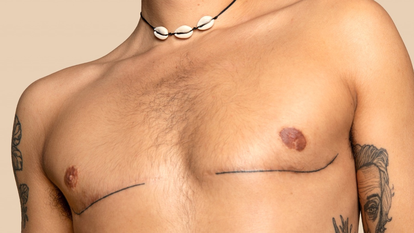 A torso with lines tattooed over top surgery scars.
