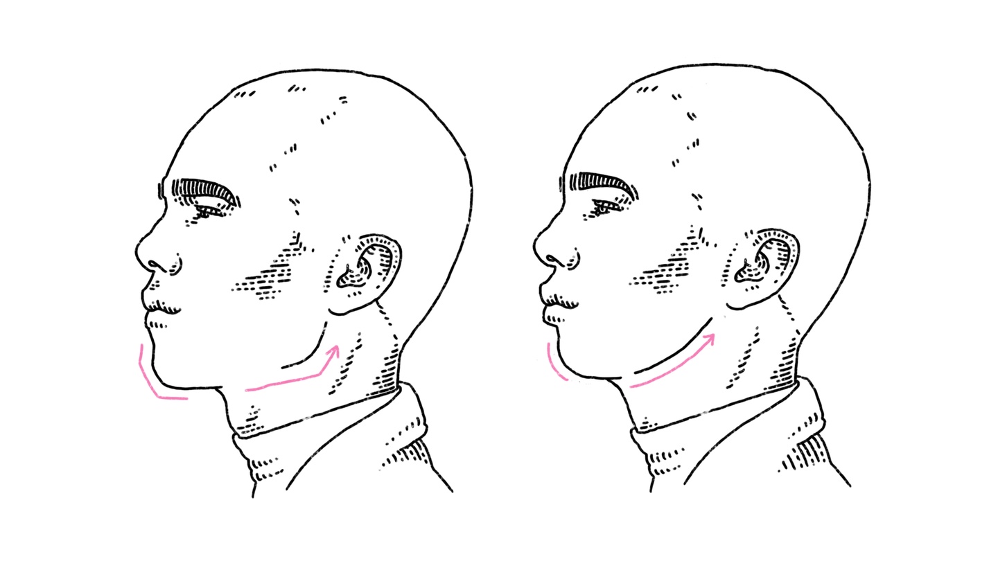 Facial Feminization illustration