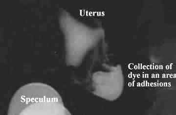 HSG image of dye collected in area of adhesions