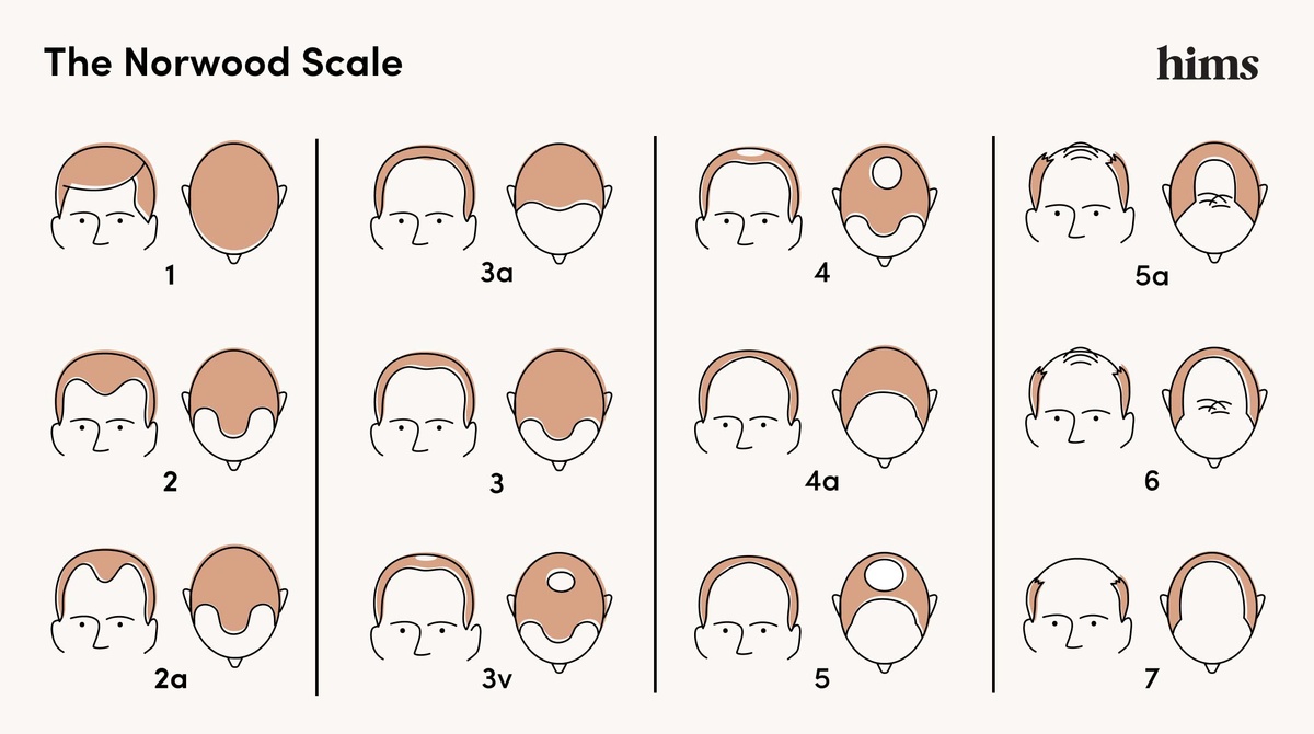 Norwood Chart Pattern Baldness