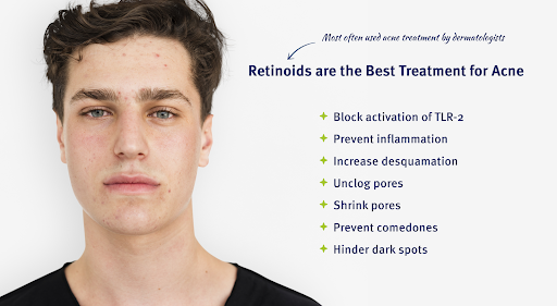 How Do Retinoids Work On Acne