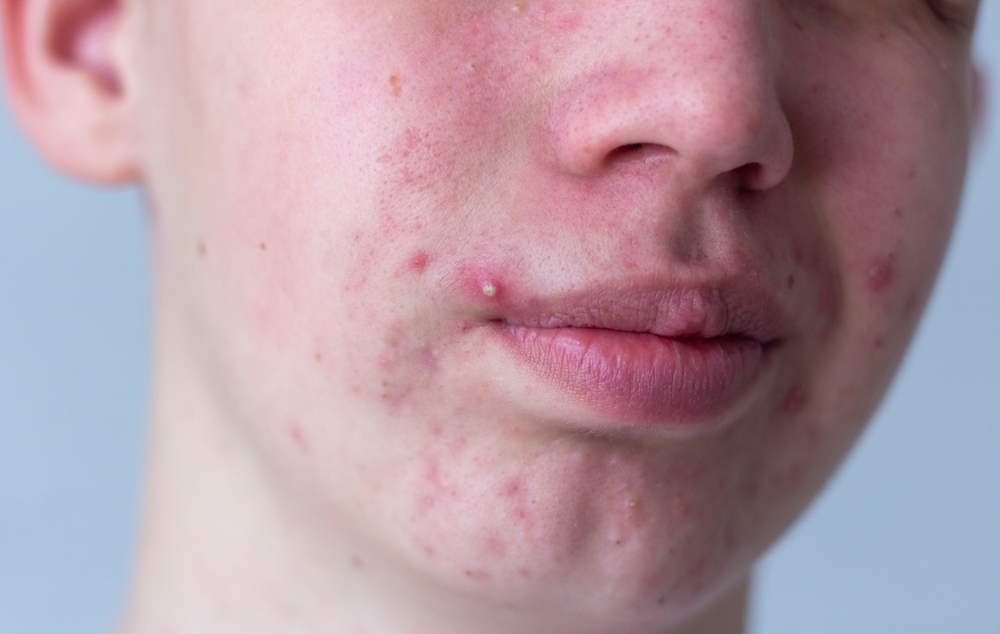 does clindamycin remove acne scars