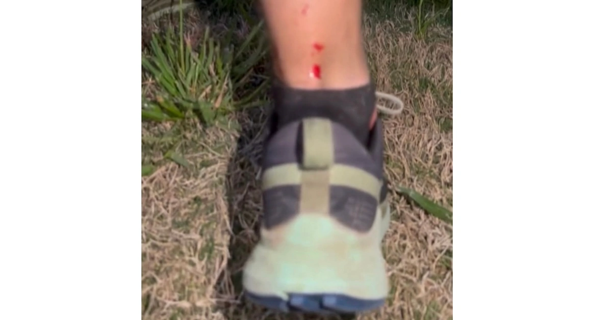 Back of a man's leg with two small bloody points
