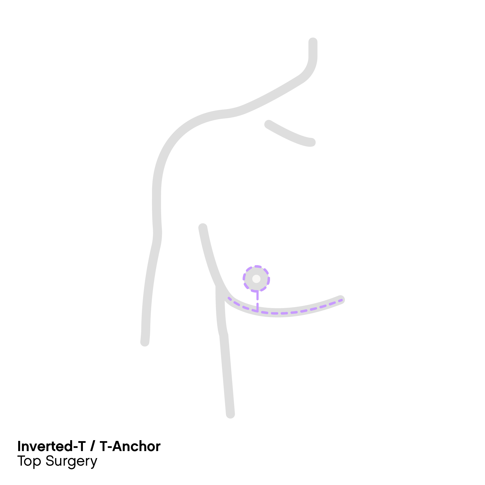 Inverted-T / T-Anchor Top Surgery