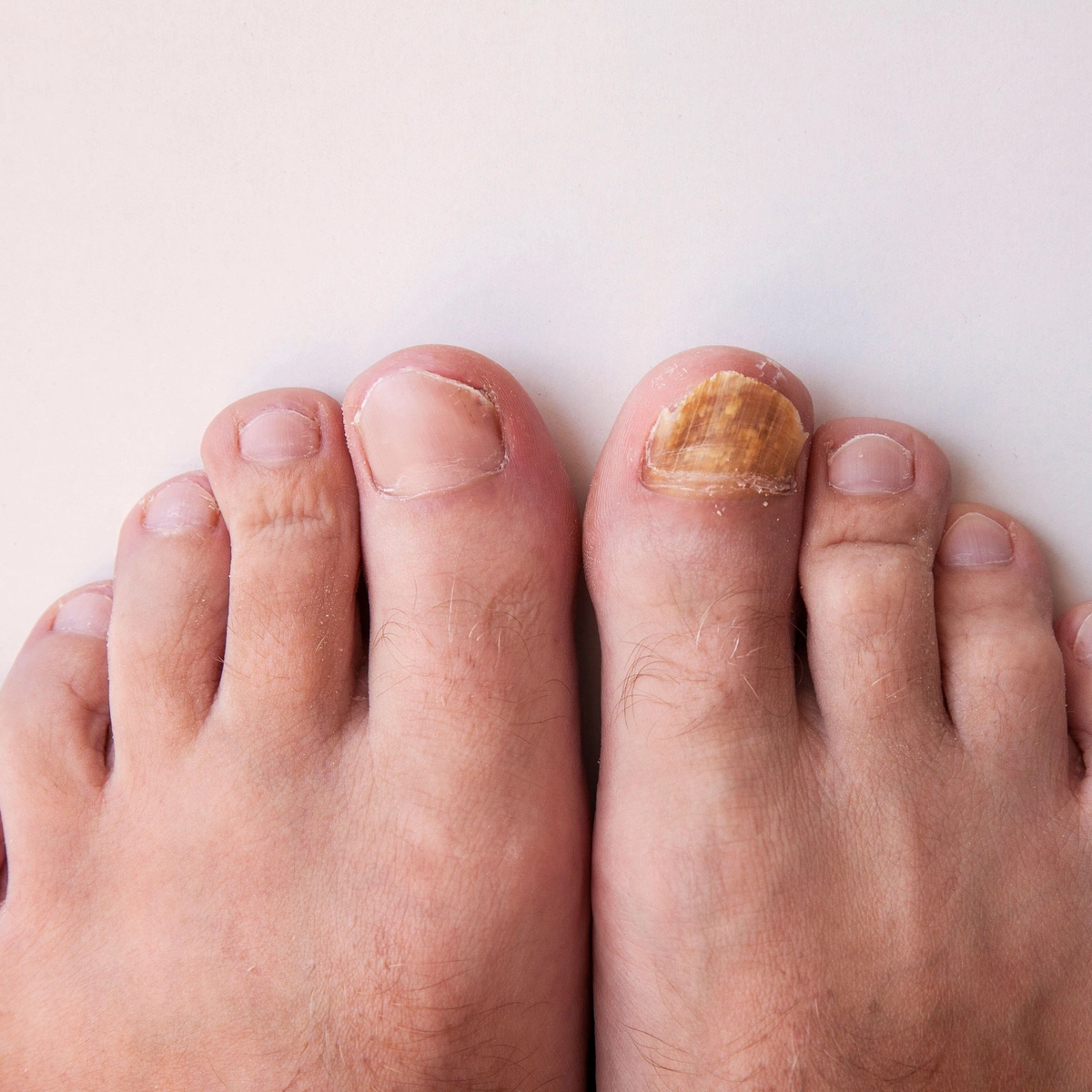 Toenail Fungus: How Does Fungus Get in There?!
