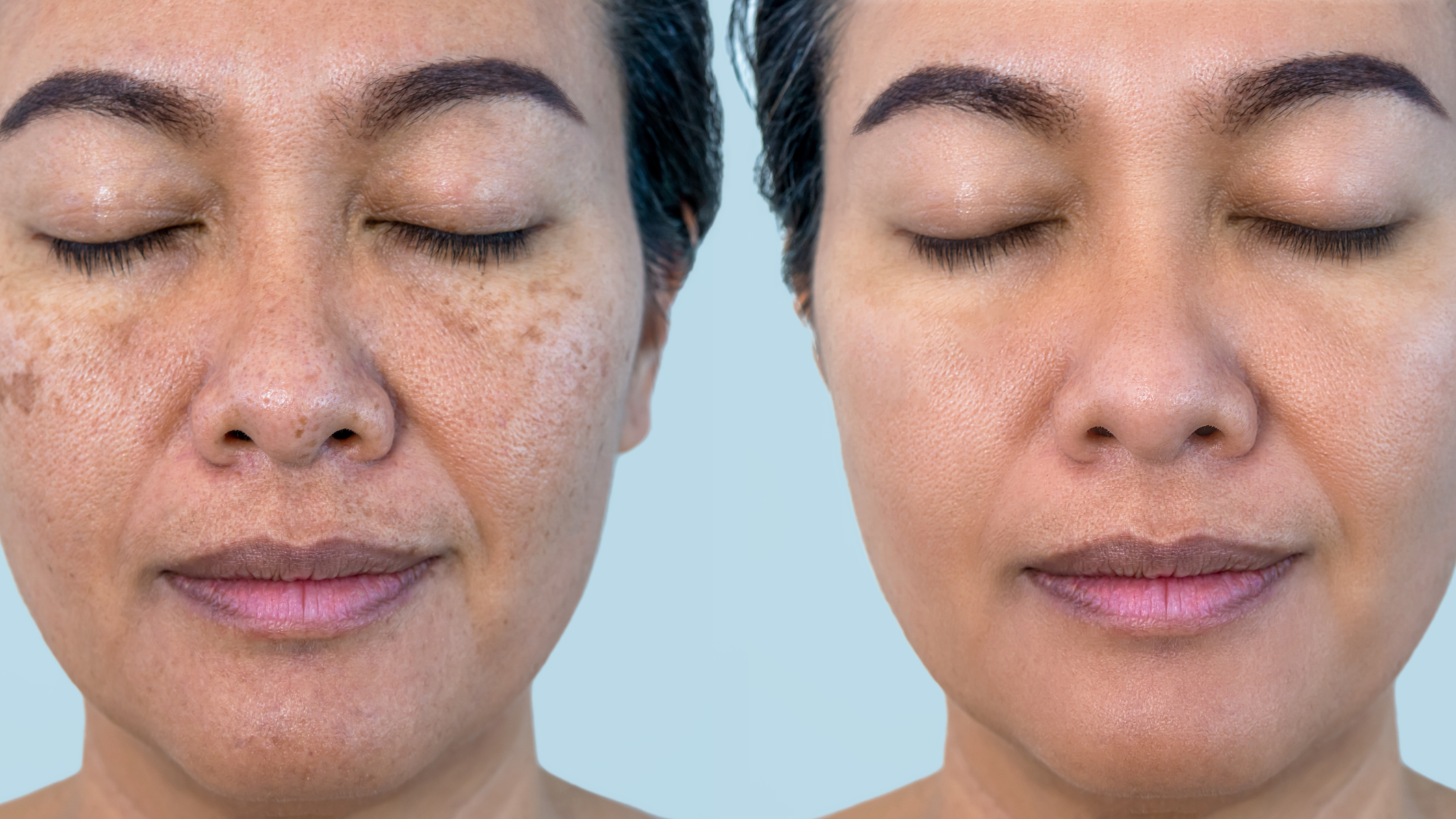 What is Melasma and why is it hard to treat?
