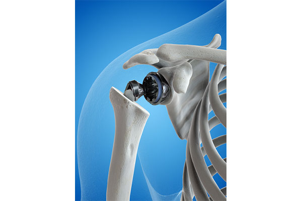 what is total shoulder replacement surgery