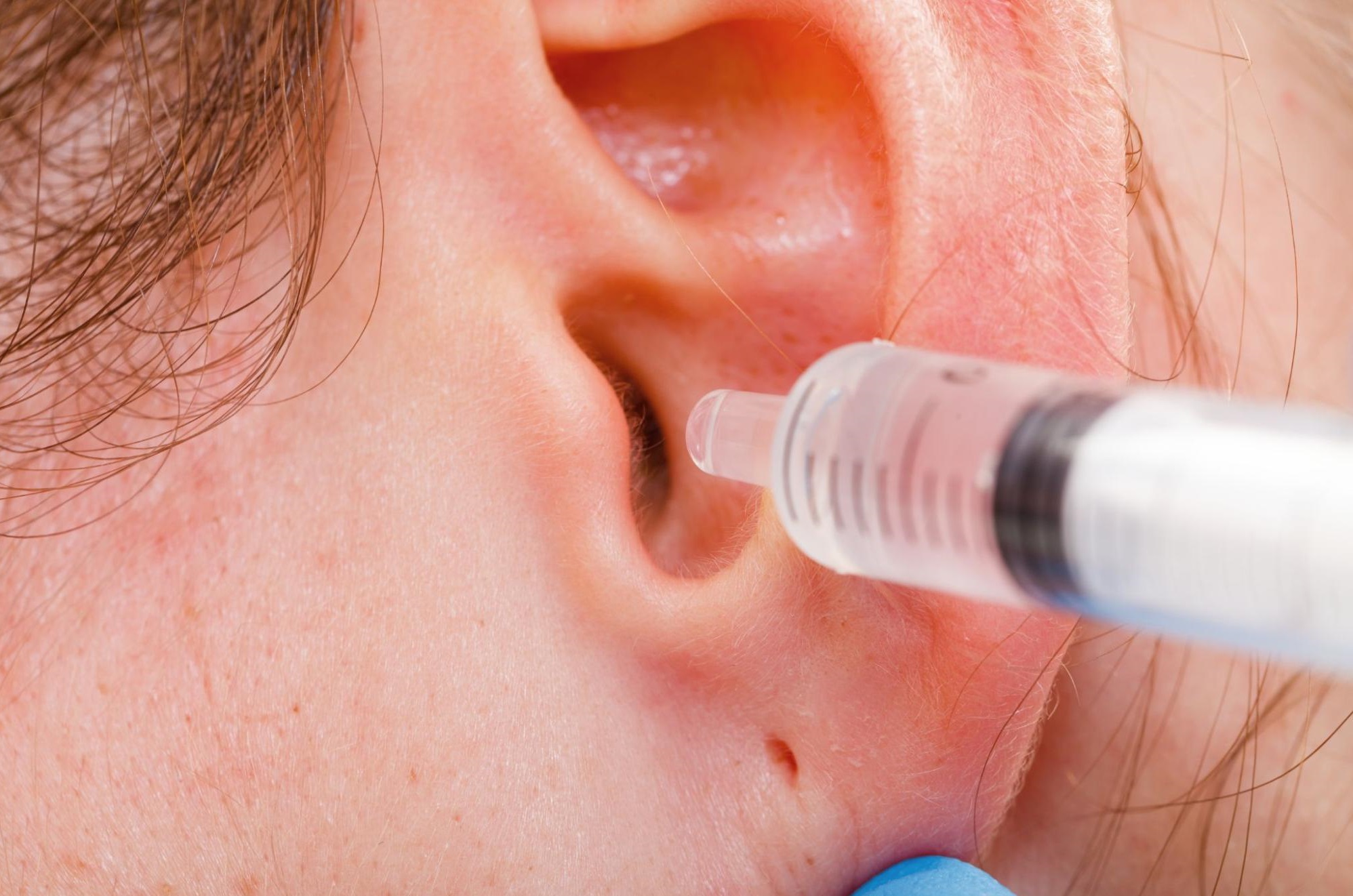 ear irrigation: Close up image of a syringe being inserted in a person's ear 