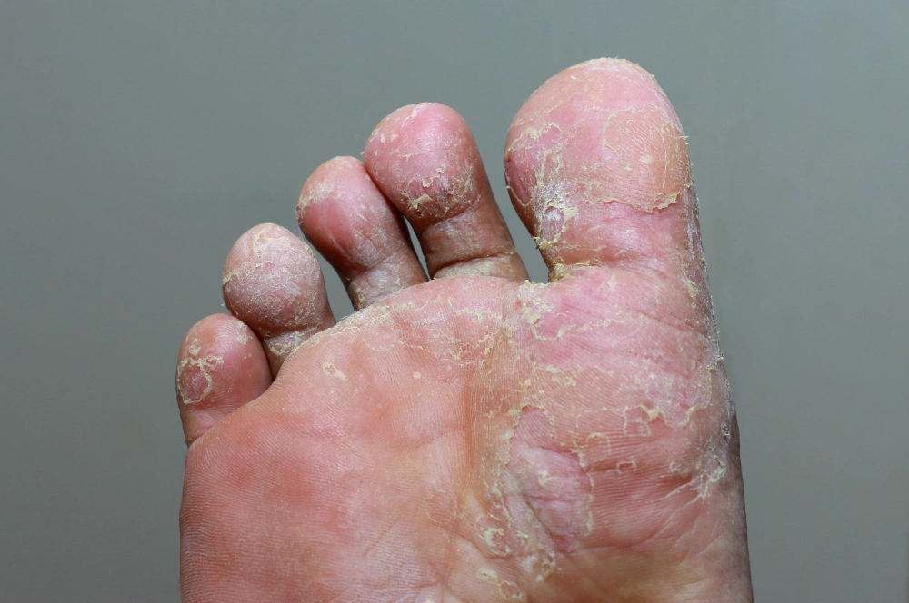 A foot with a fungal infection